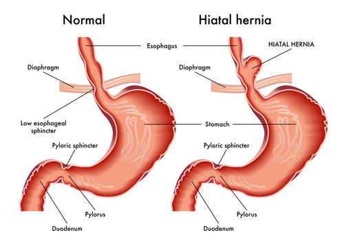 Hiatus-Hernia Disease